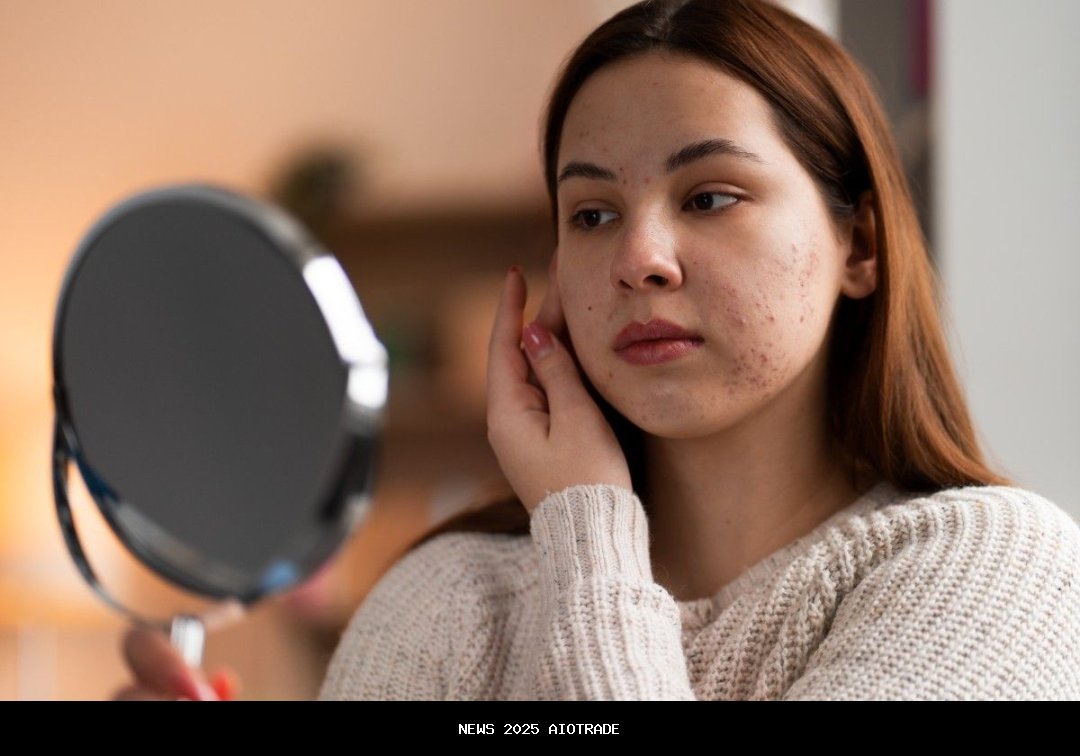 Khawatir Jerawat Muncul dari Sunscreen? 7 Tips Pilih Sunscreen untuk Kulit Berjerawat