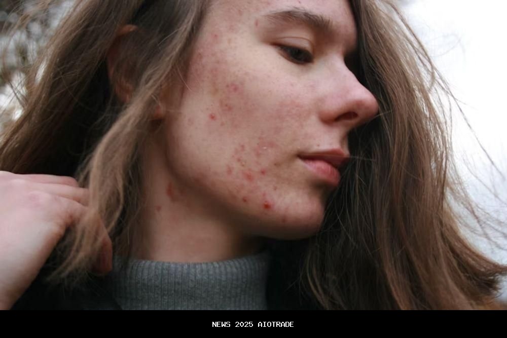 6 Cara Efektif Mengatasi Jerawat Meradang di Pipi